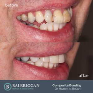 BB Composite Bonding (2)